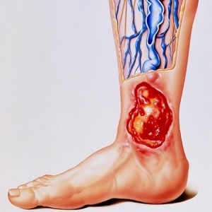 Что такое трофические язвы и как их лечить