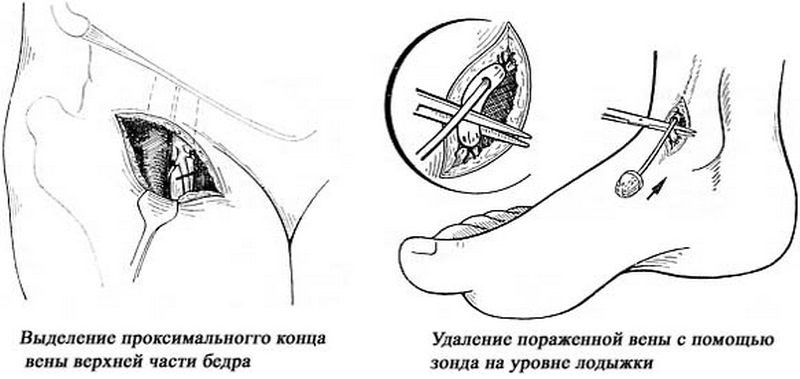 Отзывы пациентов о методах лечения варикоза