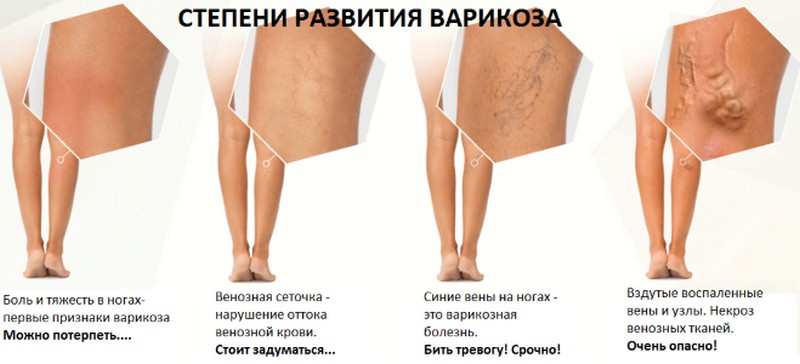 Отзывы пациентов о методах лечения варикоза