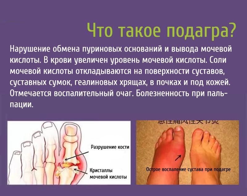 Как принимать Колхицин при подагре