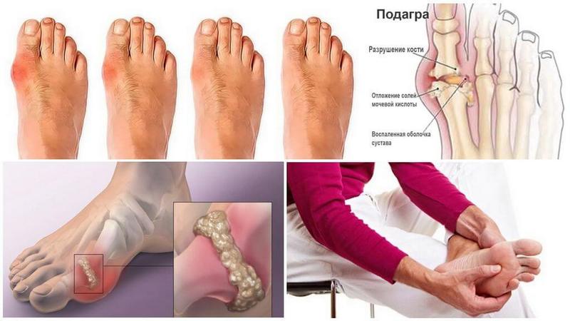 Как принимать Колхицин при подагре