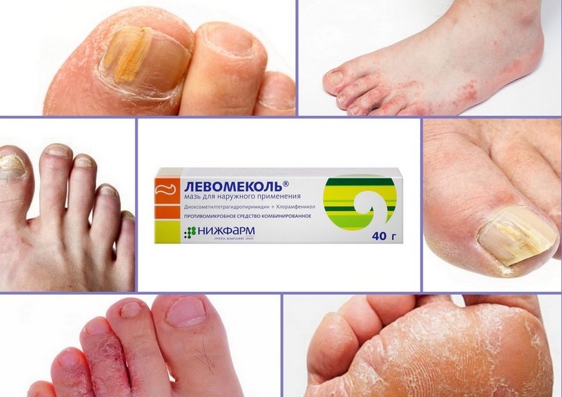Как использовать Левомеколь от грибка стоп и ногтей на ногах