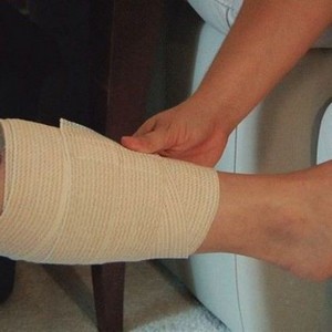 Что делать, если лопнула вена на ноге