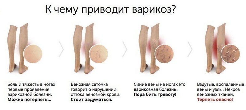 Что делать, если лопнула вена на ноге