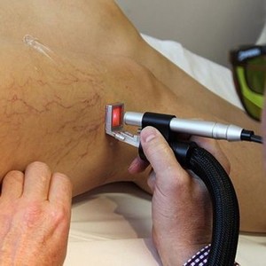 Что делать, если лопнула вена на ноге