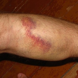 Что делать, если лопнула вена на ноге