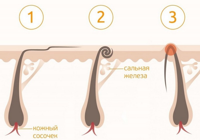 Решение проблем вросших волос лосьоном Gloria: инструкция и отзывы