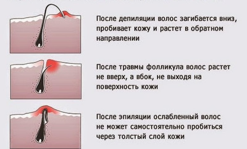 Как использовать лосьон против вросших волос Aravia professional