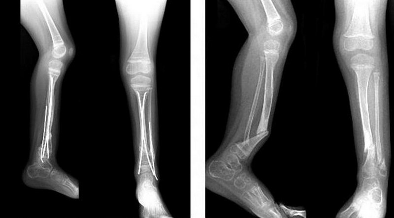 Что такое ложный сустав