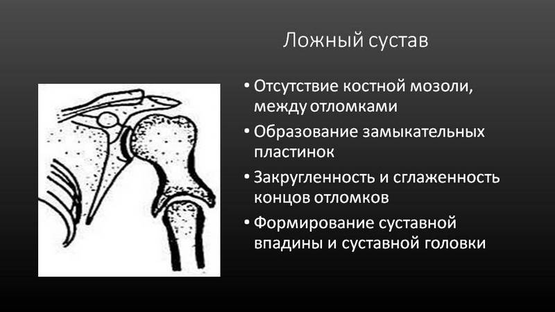 Что такое ложный сустав
