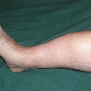 Что такое ложный сустав