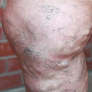 Какой массаж делается при варикозе нижних конечностей и как его делать