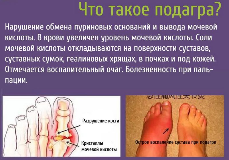 Какие мази от подагры наиболее эффективны