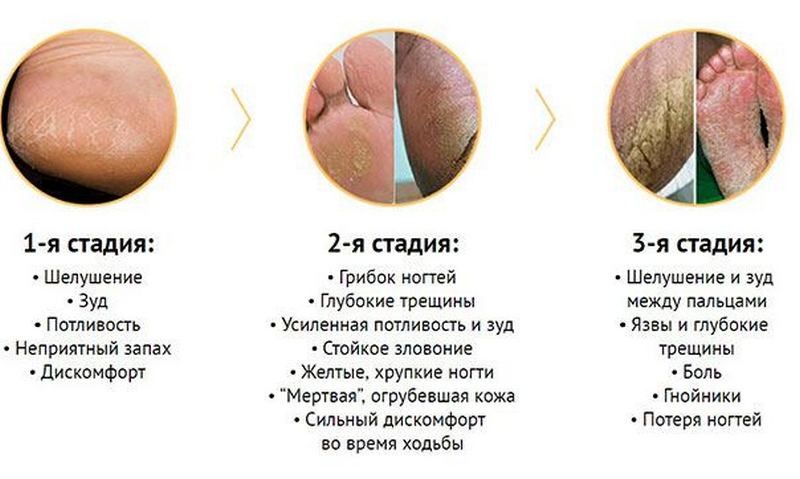 Как лечить грибок ногтей мазью Вишневского