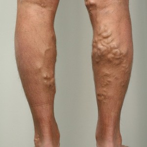 Лечение варикоза мёдом: рецепты, примочки и отзывы о методе