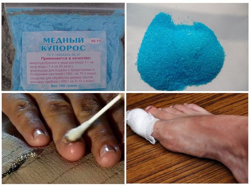 Лечение грибка ногтей медным купоросом