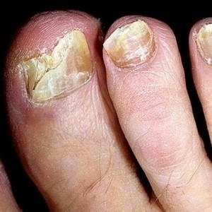 Инструкция по применению Mei Yan Qiong против грибка