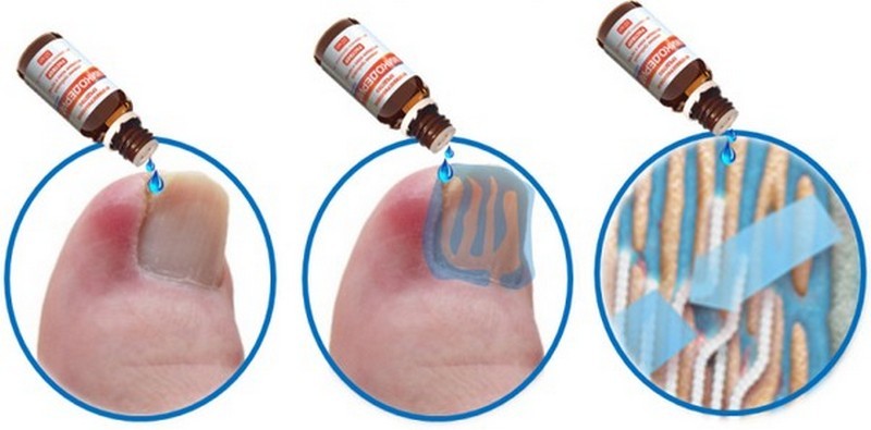 Инструкция по применению раствора Микодерил при грибке ногтей