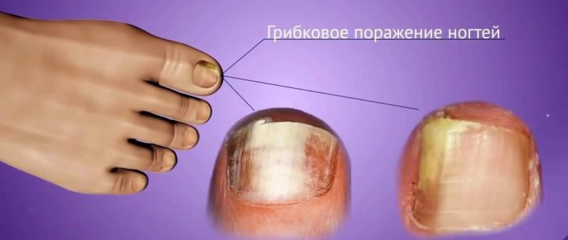 Препарат Микозан от грибка: подробная инструкция по применению