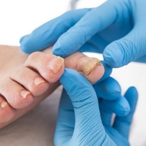 Крем Микозон для лечения грибка ногтей: инструкция по применению