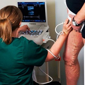 Допускаются ли занятия бегом при варикозном расширении вен на ногах