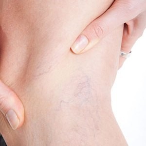 Допускаются ли занятия бегом при варикозном расширении вен на ногах