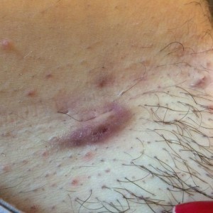 Левомеколь от вросших волос: инструкция и отзывы