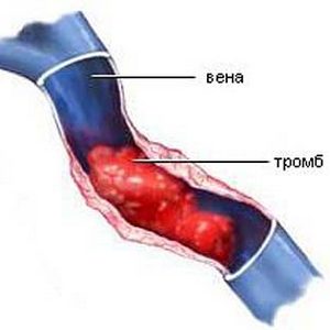 Можно ли приседать при варикозе ног или лучше воздержаться от физических нагрузок