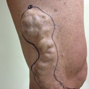 Можно ли приседать при варикозе ног или лучше воздержаться от физических нагрузок