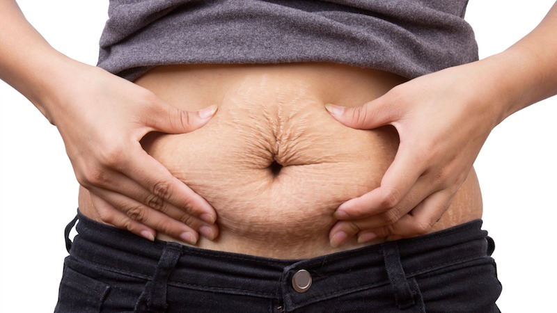 Можно ли убрать растяжки после похудения