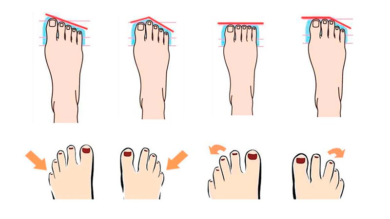 На что влияет форма стопы и каких видов она бывает?