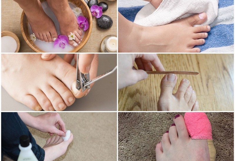 Как применять Нафтифин от грибка ногтей