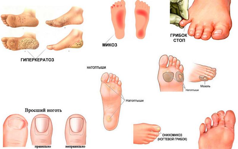 Прополис для лечения грибка ногтей ног
