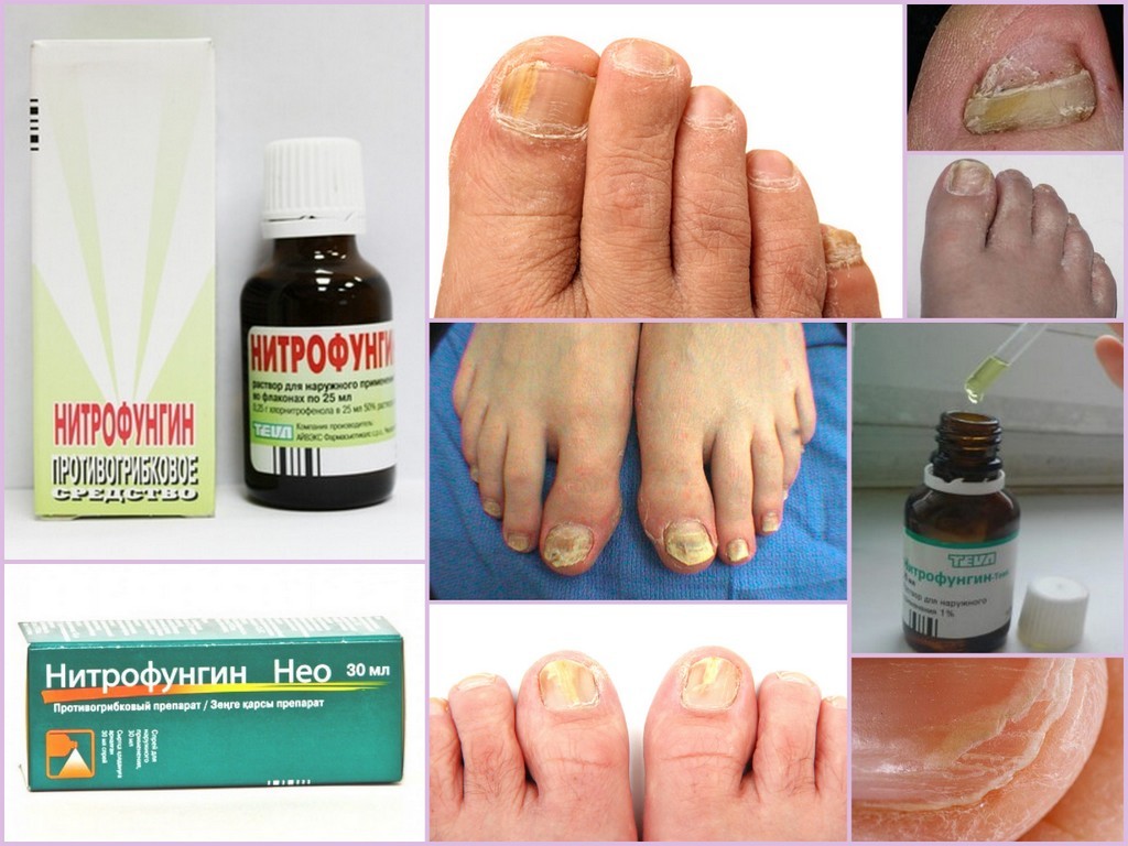 Препарат Нитрофунгин Тева: инструкция по применению