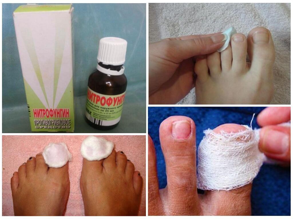 Препарат Нитрофунгин Тева: инструкция по применению