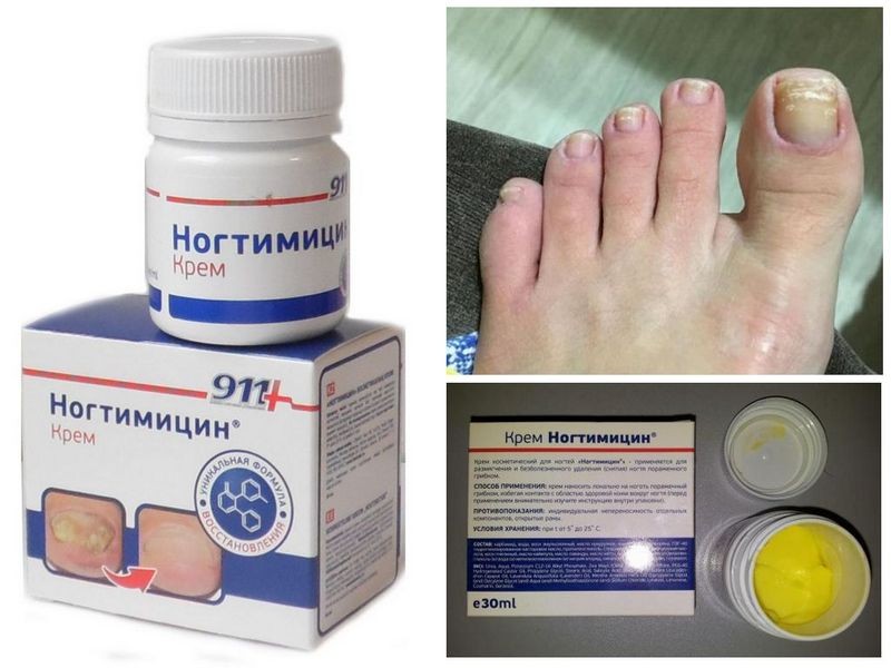 Как использовать крем Ногтимицин для лечения грибка ногтей