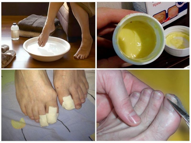 Как использовать крем Ногтимицин для лечения грибка ногтей