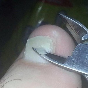 Ногтивит усиленный: инструкция по применению