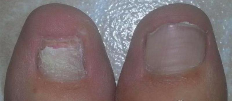 Ногтивит усиленный: инструкция по применению