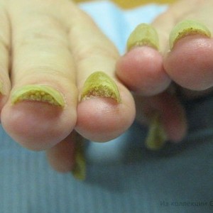 Как лечить Онихолизис ногтей