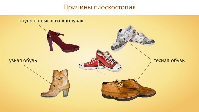 Какую обувь носить при плоскостопии