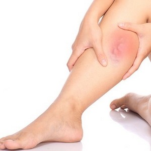 Возможные осложнения при варикозе вен нижних конечностей