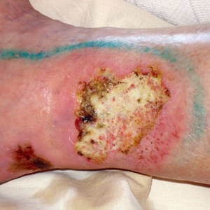 Возможные осложнения при варикозе вен нижних конечностей