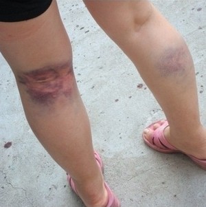 Возможные осложнения при варикозе вен нижних конечностей