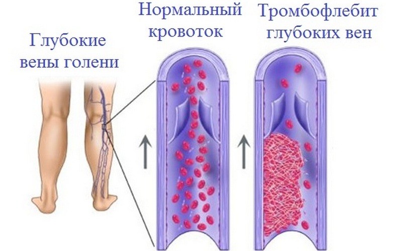 Возможные осложнения при варикозе вен нижних конечностей