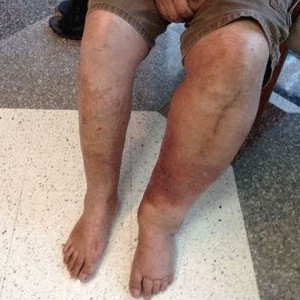 Что делать если отекают ноги у пожилого человека: средства для лечения отечности ног