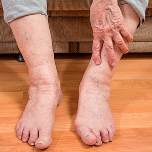 Что делать если отекают ноги у пожилого человека: средства для лечения отечности ног