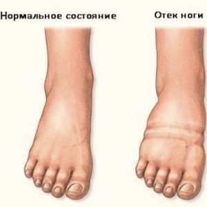Эффективное лечение отеков ног при варикозе