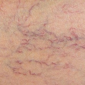 Эффективное лечение отеков ног при варикозе