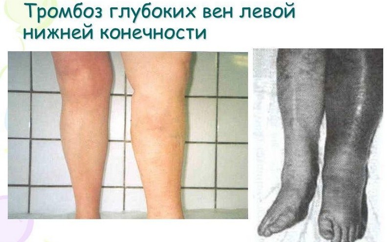 Отзывы пациетов об операциях лазером при варикозе